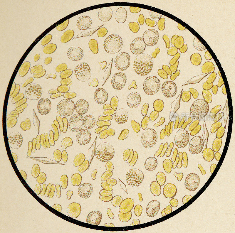 人类血液细胞与Charcot-Leyden晶体从最近去世的白血病患者- 19世纪显微镜观察